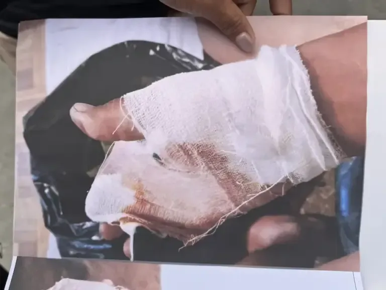 Image of the injured hand of Yovana Muñoz's husband after being shot in combat. (Photo: Diego Aquino)
